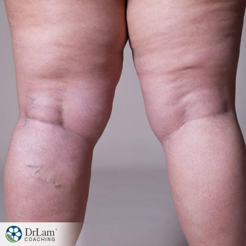 Lipedema: What It Is and How to Improve It